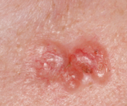 The Signs of Skin Cancer | Cancer Council NSW