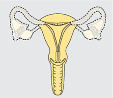 oophorectomy salpingo bilateral surgery cervical fallopian