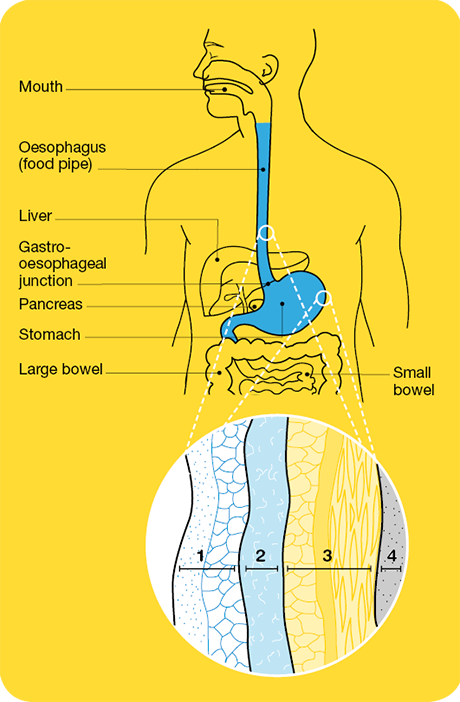 Oesophageal Cancer Cancer Council Nsw