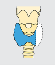 thyroid thyroidectomy