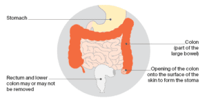 Stomas | Bowel Cancer | Cancer Council NSW