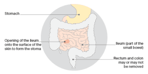 Stomas | Bowel Cancer | Cancer Council NSW