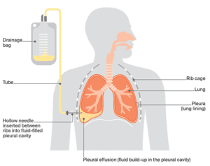 Breathlessness | Lung Cancer | Cancer Council NSW