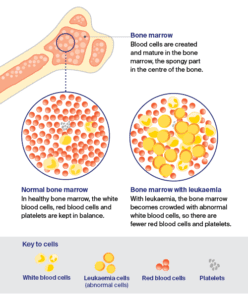 About Acute Lymphoblastic Leukaemia (ALL) | Cancer Council NSW