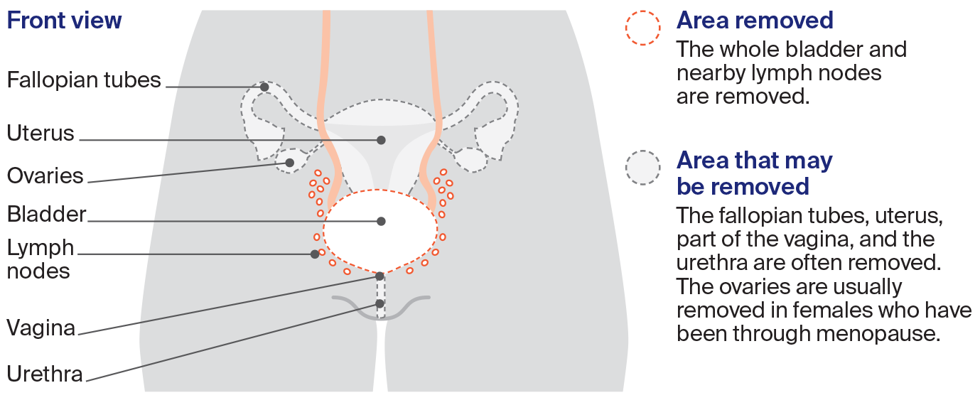 Diagram: Cystectomy in females