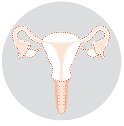 Diagram: Total hysterectomy and bilateral salpingo-oophorectomy