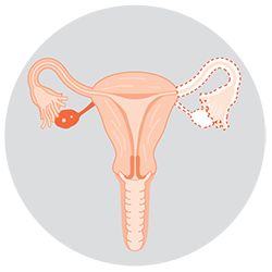 Diagram: Unilateral salpingo-oophorectomy