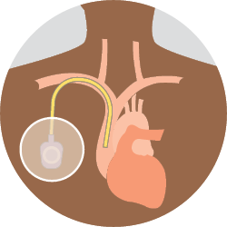 Diagram: Central venous access device (CVAD)