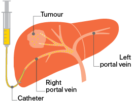 portal vein embolisation (PVE) - Image 1