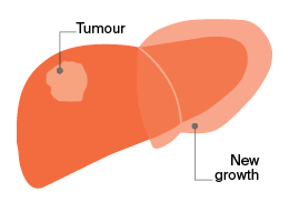 portal vein embolisation (PVE) - Image 2