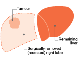 portal vein embolisation (PVE) - Image 3