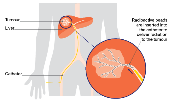 Selective internal radiation therapy (SIRT) combines embolisation with internal radiation therapy 