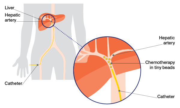 Transarterial chemoembolisation (TACE) delivers chemotherapy directly to a tumour while blocking its blood supply (embolisation). It is done by an interventional radiologist.