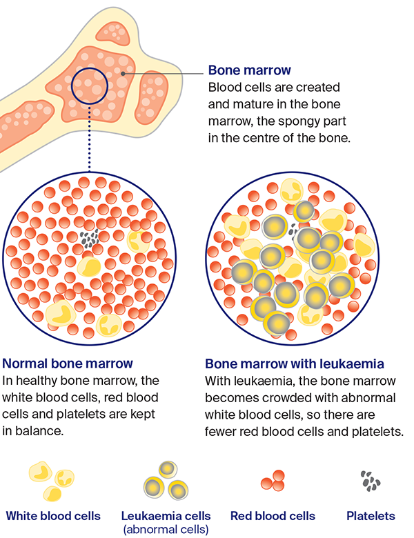 Diagram: How leukaemia start?