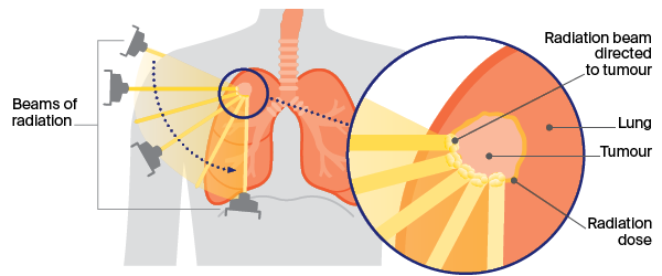 Diagram - how radiation is done