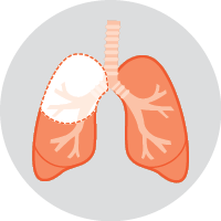 Diagram of  a Lobectomy - This is the most common type of surgery
for lung cancer. In a lobectomy, one of the
lobes of the lung (about 30–50% of the lung)
is removed.