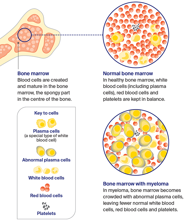 Diagram showing how Myeloma starts.  Myeloma starts when plasma cells become abnormal and multiply, crowding the bone marrow. They usually also release an antibody (paraprotein) into the blood.