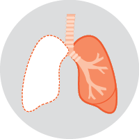 Diagram of a Pneumonectomy - If the cancer is in more than one lobe of a lung, or near where the airways enter the lung, a pneumonectomy may be done. In this operation, a whole lung is removed. It’s possible to still breathe normally with one lung.