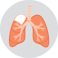 Diagram of Segmentectomy - For some early-stage lung cancers that are on
the edge of the lung, a segmentectomy may be
used. In this operation, a small part of the lobe
is removed.