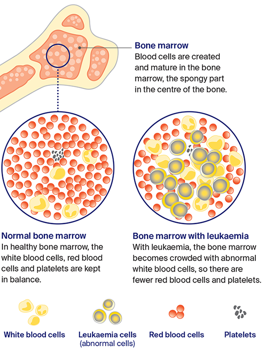 Image showing the process of how leukaemia starts